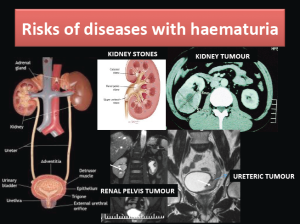 Blood in urine, Hematuria, Hematuria consultant