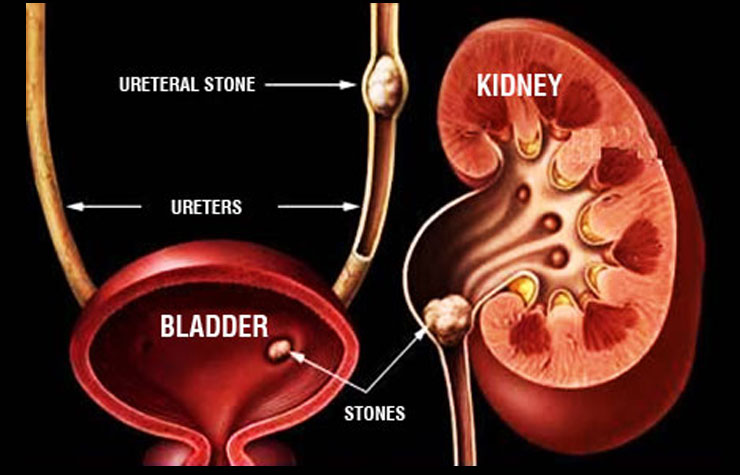 Kidney Stone, Urology Specialist in Dubai, Kidney problem